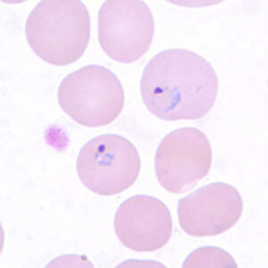 malaria sample