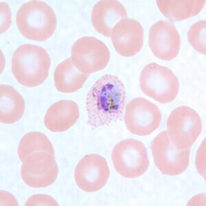 malaria sample