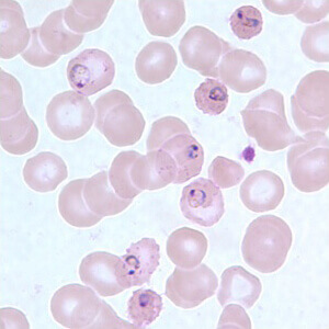 malaria sample