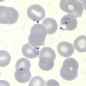 malaria sample