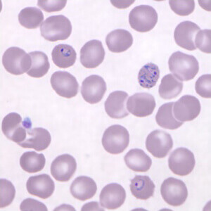 malaria sample