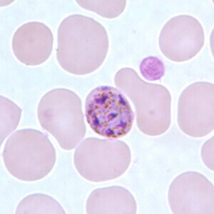 malaria sample